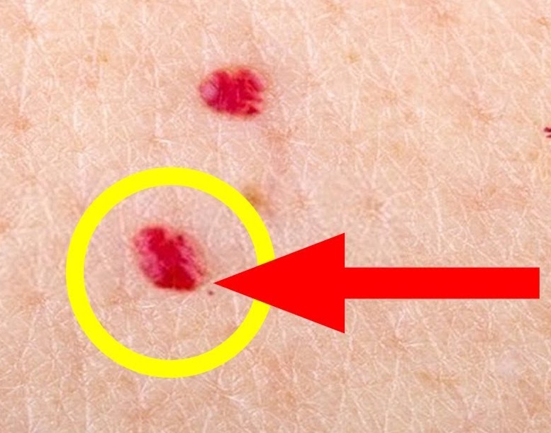 Put Off Ape Generally Blood Spots On Skin Pictures To Give Permission